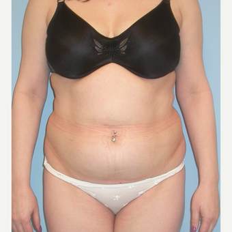 35-44 year old woman treated with Tummy Tuck before 3053539