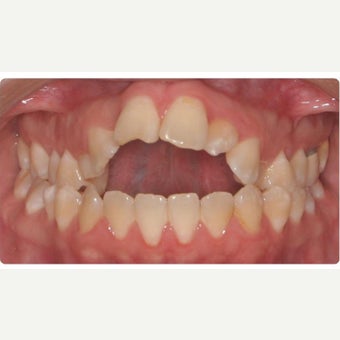 25-34 year old woman treated with Braces 1743037