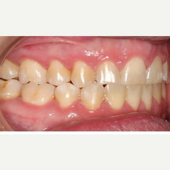 25-34 year old woman treated with Braces after 1743037