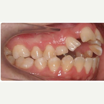 25-34 year old woman treated with Braces before 1743037