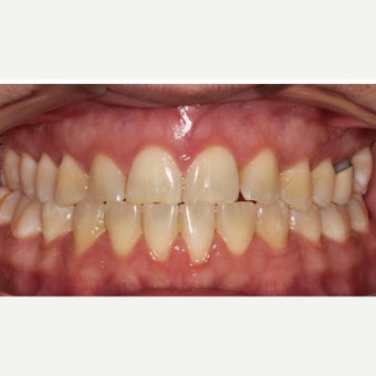 25-34 year old woman treated with Braces 1743037