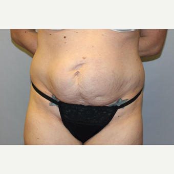 25-34 year old woman treated with Tummy Tuck before 3529179