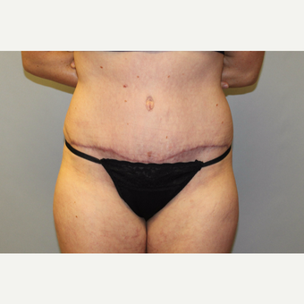 25-34 year old woman treated with Tummy Tuck after 3529179