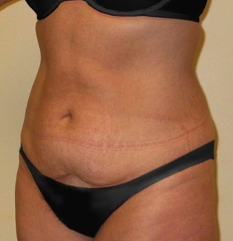 Tummy Tuck before 1219911