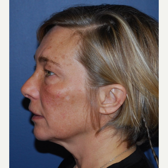 45-54 year old woman treated with Mini Lift before 3428308