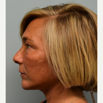 45-54 year old woman treated with Mini Lift after 3428308