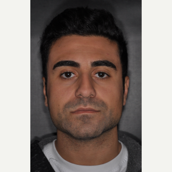 18-24 year old man treated with Nose Surgery 6 weeks post-op before 3500197