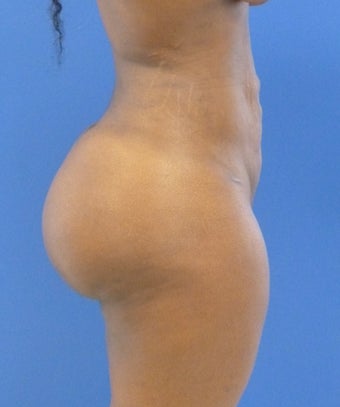 24 y.o. female – Liposuction of abdomen, flanks, & back with fat transfer to buttocks – 1250cc per side 1359587