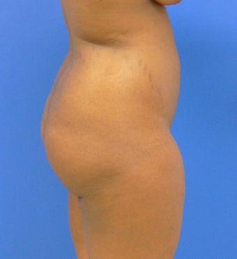 24 y.o. female – Liposuction of abdomen, flanks, & back with fat transfer to buttocks – 1250cc per side 1359587