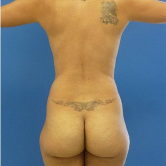 29 y.o. female – Liposuction of abdomen, flanks, and back with fat transfer to buttocks – 1400cc pe before 1895306
