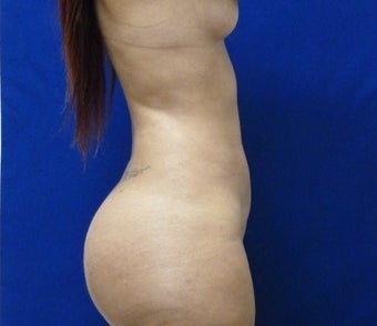 29 y.o. female – Liposuction of abdomen, flanks, and back with fat transfer to buttocks – 1400cc pe 1895306