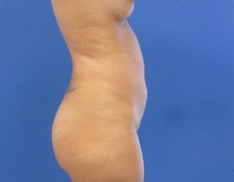 29 y.o. female – Liposuction of abdomen, flanks, and back with fat transfer to buttocks – 1400cc pe 1895306