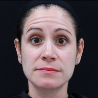 38 year old female treated with Botox for forehead lines. before 3724518