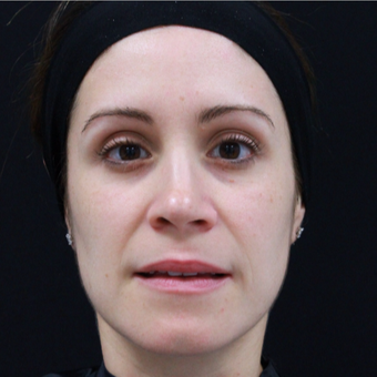 38 year old female treated with Botox for forehead lines. after 3724518