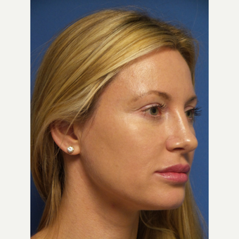 33 year old woman treated with Rhinoplasty and septoplasty after 3326240