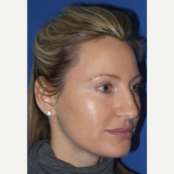 33 year old woman treated with Rhinoplasty and septoplasty before 3326240