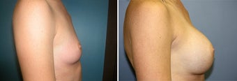 Breast Augmentation 328463