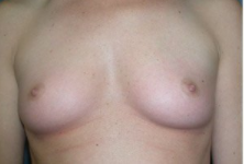 Breast Augmentation before 328463