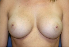 Breast Augmentation after 328463