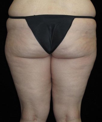 26 year old woman treated with Thigh Lift 3251759