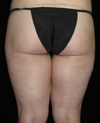 26 year old woman treated with Thigh Lift 3251759