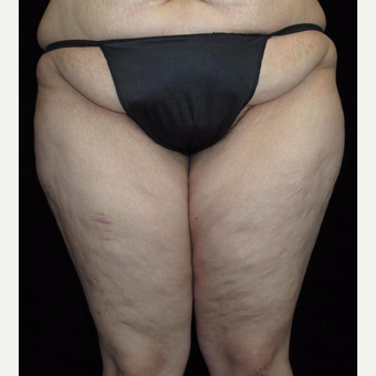 26 year old woman treated with Thigh Lift before 3251759