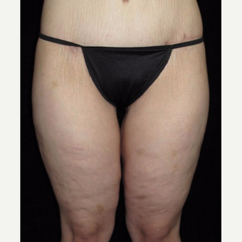 26 year old woman treated with Thigh Lift after 3251759