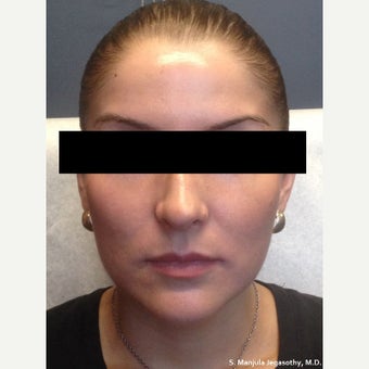 Facial Shaping with Voluma® and Dysport® after 1770687
