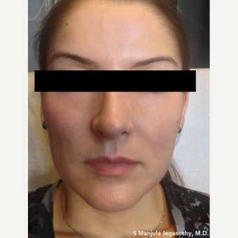 Facial Shaping with Voluma® and Dysport® before 1770687