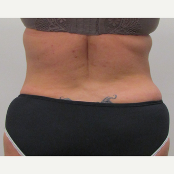 Tumescent Liposuction of the Sides for This 42 Year Old Woman after 3181976
