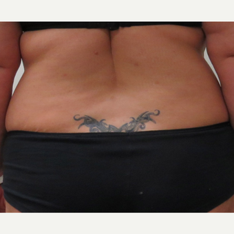 Tumescent Liposuction of the Sides for This 42 Year Old Woman before 3181976