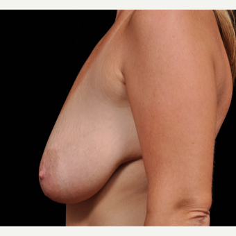 35-44 year old woman treated with Breast Augmentation before 3617810