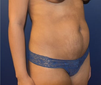 35-44 year old woman treated with Tummy Tuck before 3348767