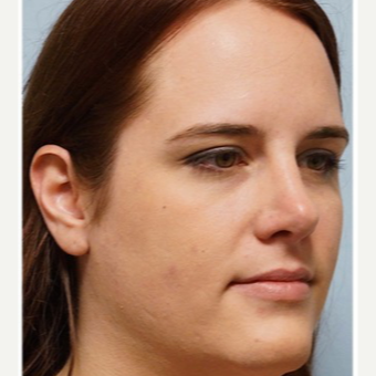 25-34 year old woman treated with Rhinoplasty after 3691920