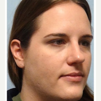 25-34 year old woman treated with Rhinoplasty before 3691920