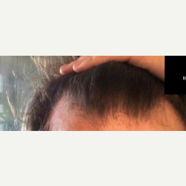 Male Patient Hair Transplant before 3420924