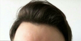 Male Patient Hair Transplant after 3420924