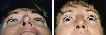 Before and after septoplatsy before 798179