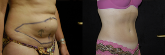 Tummy Tuck after 962943