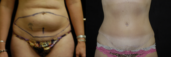 Tummy Tuck before 962943