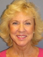 55-64 year old woman treated with Neck Lift after 3103945