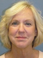 55-64 year old woman treated with Neck Lift before 3103945