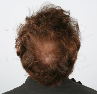 2 FUT: 6103 grafts 13015 hairs - Result after 1 year post-op 3162304
