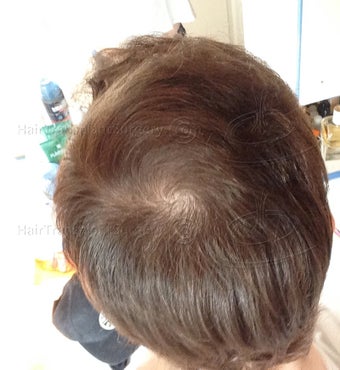 2 FUT: 6103 grafts 13015 hairs - Result after 1 year post-op 3162304