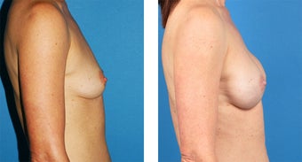 54 Year Old Woman, Cassileth One-Stage Breast Reconstruction after 1039907