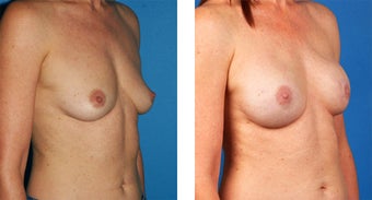 54 Year Old Woman, Cassileth One-Stage Breast Reconstruction 1039907