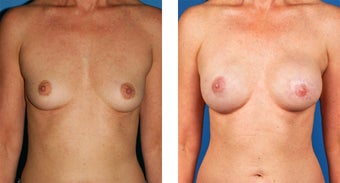 54 Year Old Woman, Cassileth One-Stage Breast Reconstruction before 1039907
