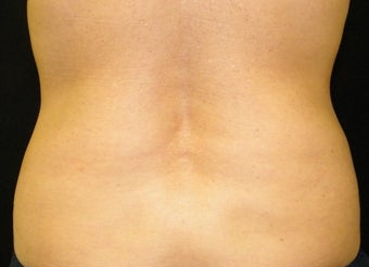 CoolSculpting after 965303