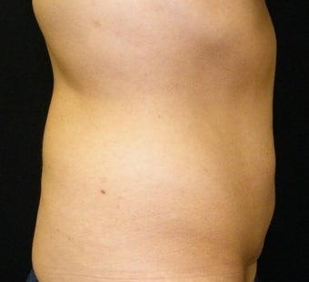 CoolSculpting 965303