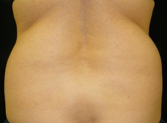 CoolSculpting before 965303